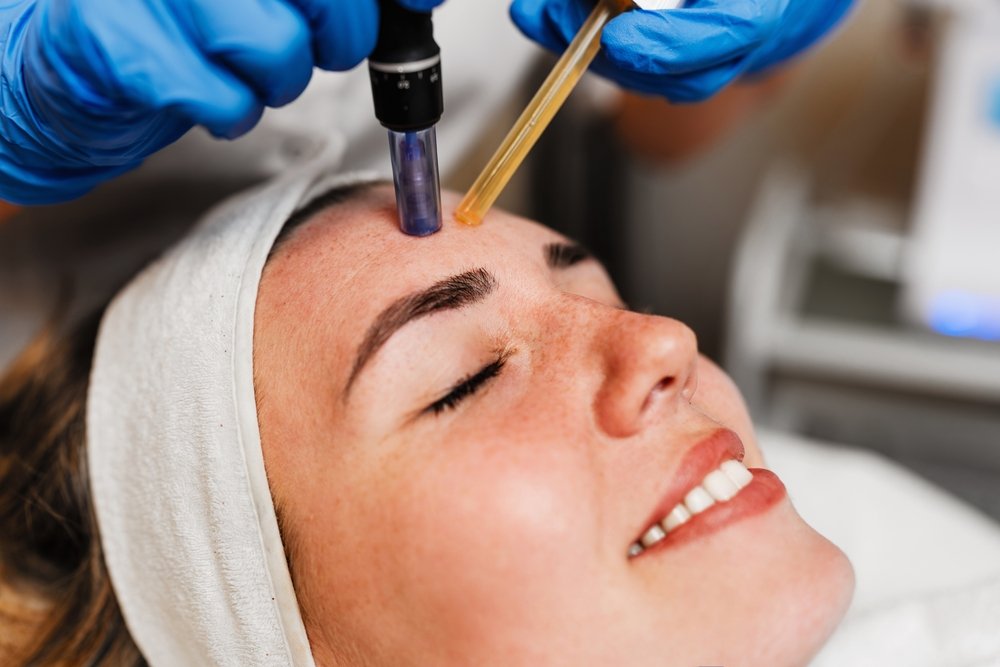 What Is PRP Microneedling?